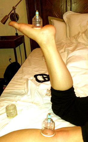 Kelly Osbourne, Twitter, Cupping Kelly Osbourne, Twitter, Cupping